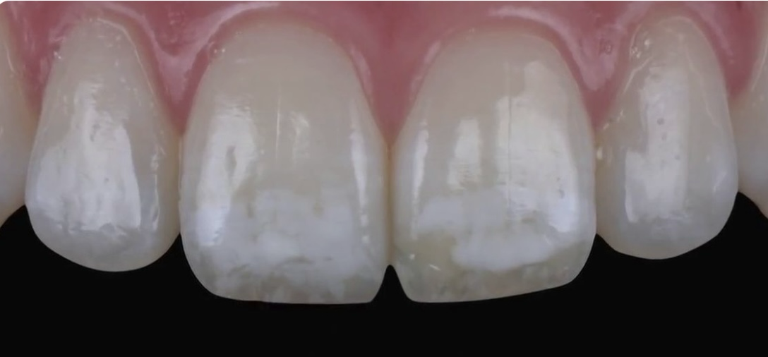 بلیچینگ و لکه سفید