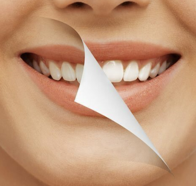 بلیچینگ دندان