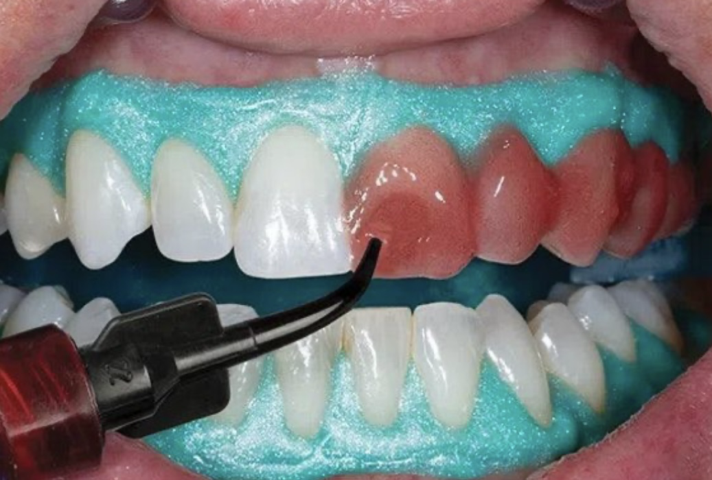 بلیچینگ حساسیت تا ماندگاری